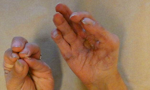 Bekapta az egyik dolgozó kezét a baromfifeldolgozóban a bőrlehúzó gép, maradandó sérülést szenvedett az asszony