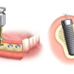 Mi az oka a fogászati implantátum gyulladásának?