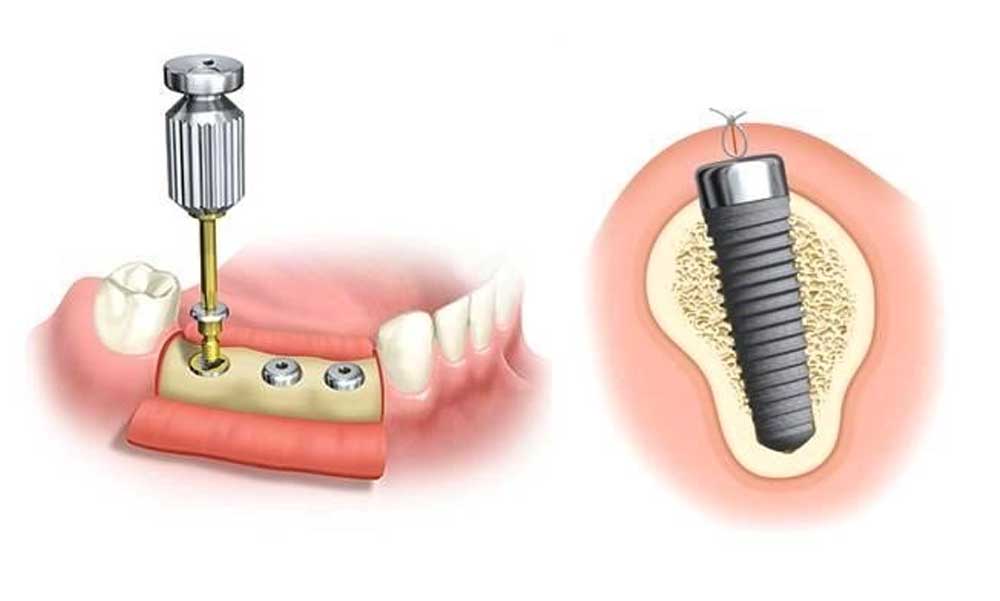 Mi az oka a fogászati implantátum gyulladásának?