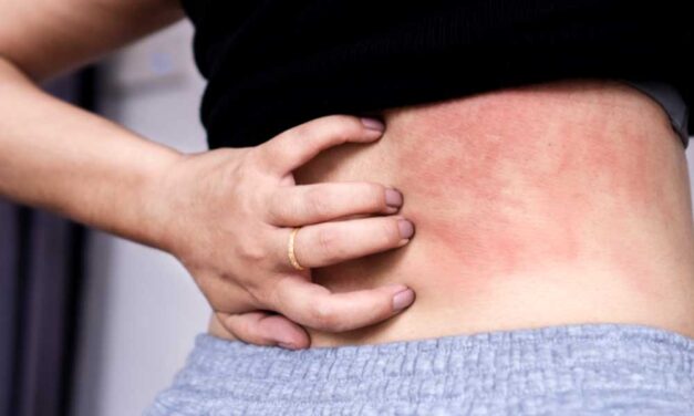 Mi állhat a bőrkiütések hátterében?