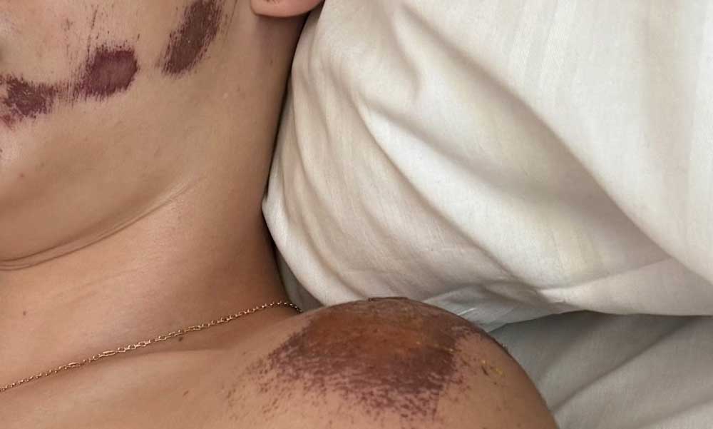 Súlyos rollerbaleset: a hasába fúródott a kormány, lépszakadást szenvedett a 17 éves Mana