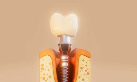 Fog implantátum hátrányai – mitől félünk valójában?