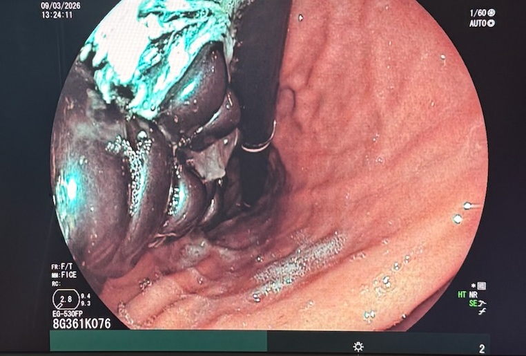 20 mágnest nyelt le egy 10 éves gyerek, a Heim Pál kórházban mentették meg az életét